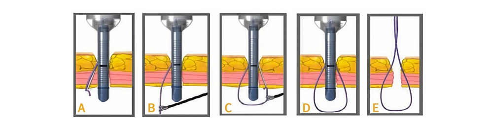 Disposable Puncture Suturing Device